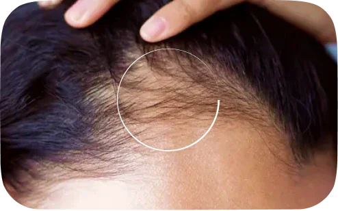 Close-up of scalp with thinning hair and fingers parting dark hair to show hair loss