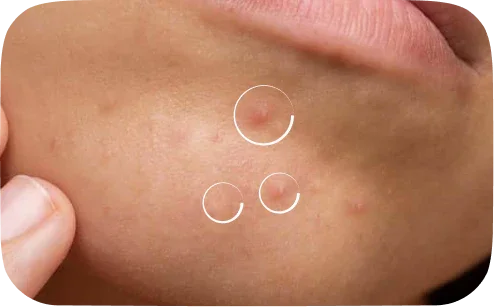 Close-up of chin with acne pimples on light brown skin, fingers touching cheek