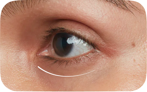 Dark Circle/Under Eye