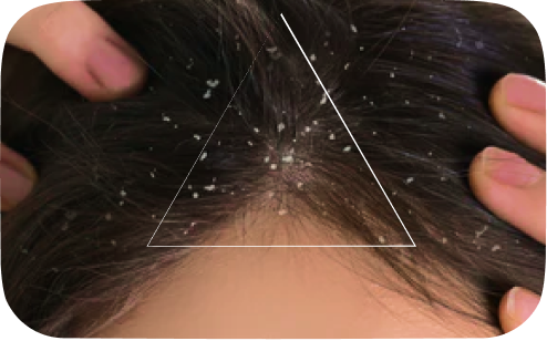 Scalp & Dandruff