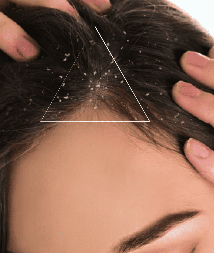 Dandruff