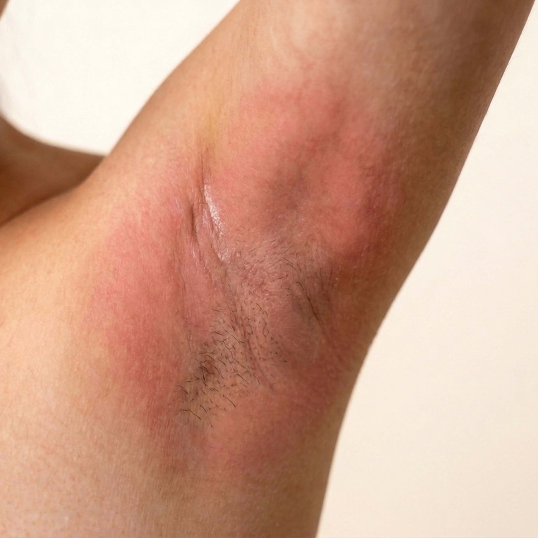Hot Wax Burns